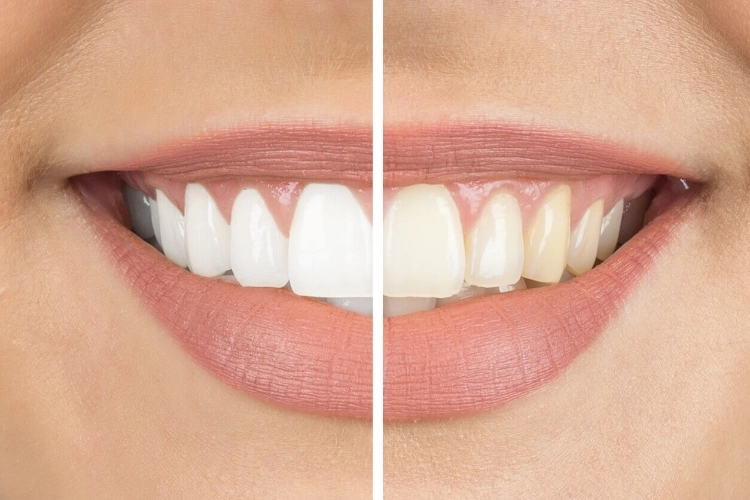 Dişleri Beyazlatmaya Yardımcı Olan 5 Gıda-3 - Saç Bakım Güzellik