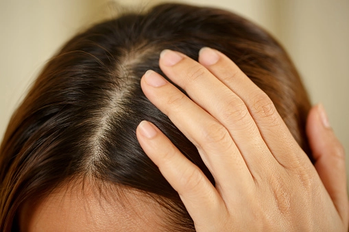 Kadınlarda Saç Dökülmesi için Bakım Önerileri-3 - Saç Bakım Güzellik