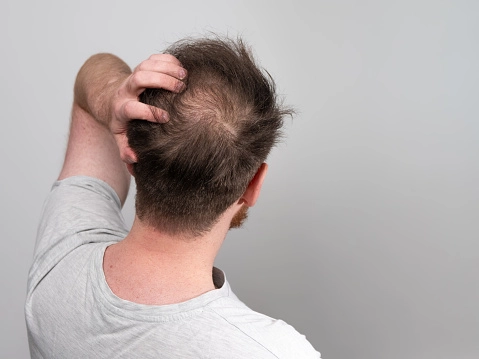Erkeklerde Saç Dökülmesi için Bakım Önerileri-1 - Saç Bakım Güzellik