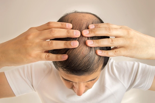 Erkeklerde Saç Dökülmesi için Bakım Önerileri-5 - Saç Bakım Güzellik