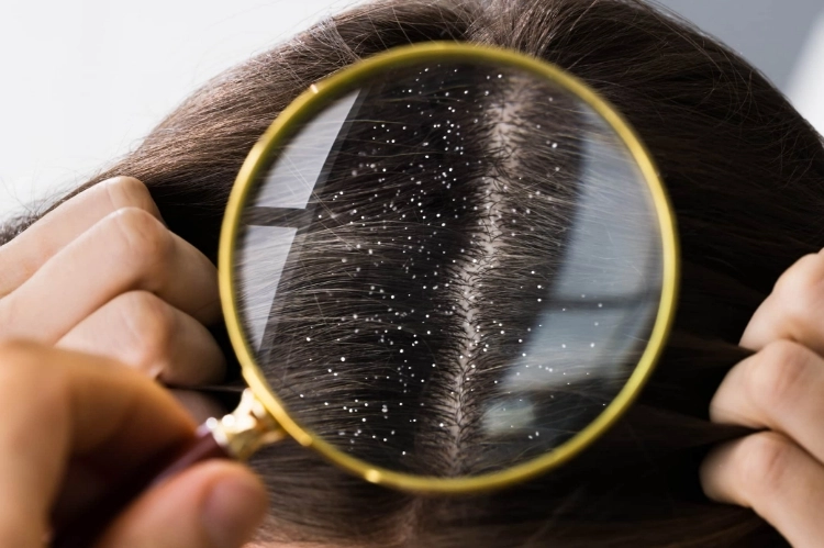 Daha Dolgun Saçlar İçin Saç Derisi Peelingi-3 - Saç Bakım Güzellik