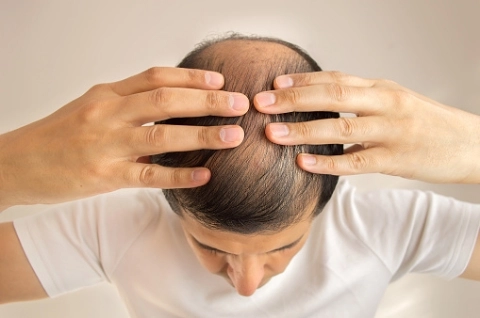 Erkeklerde Saç Dökülmesi için Bakım Önerileri-6 - Saç Bakım Güzellik