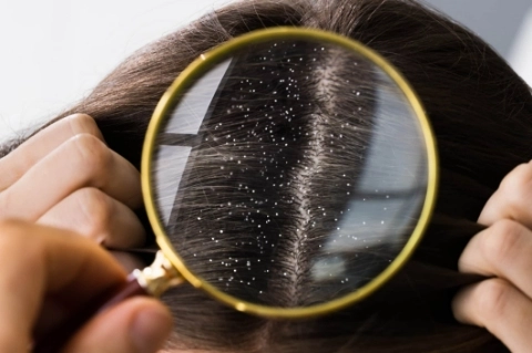Daha Dolgun Saçlar İçin Saç Derisi Peelingi-4 - Saç Bakım Güzellik