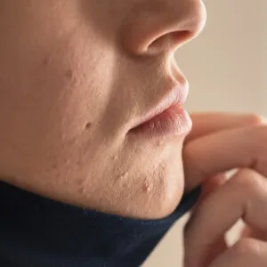 Yeni Gerçeğimiz: Maskne Nedir? - Saç Bakım Güzellik
