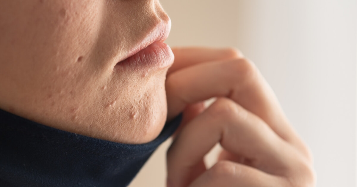 Yeni Gercegimiz Maskne Nedir Sac Bakim Guzellik